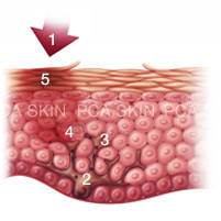 Hyperpigmentation