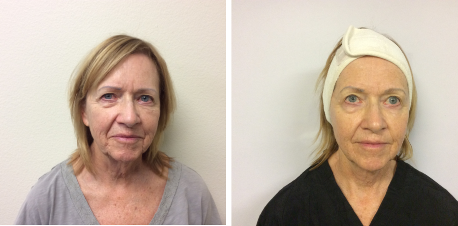 Neurotris Sculpting