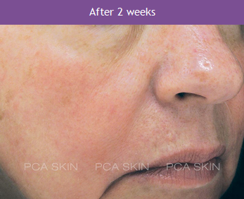 PCA 2 Weeks After