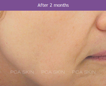 Visible Aging - After