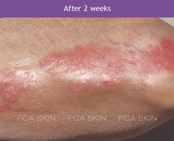 Psoriasis - After