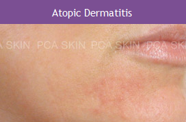 Atopic Dermatitis
