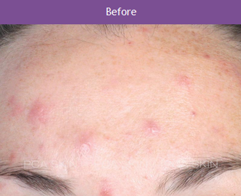 PCA Before