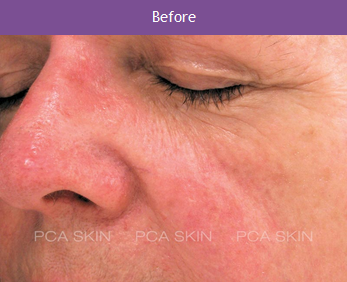 Rosacea - Before