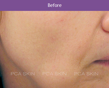Visible Aging - Before