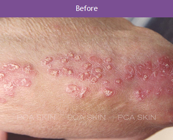 Psoriasis - Before