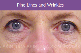 Fine Lines & Wrinkles
