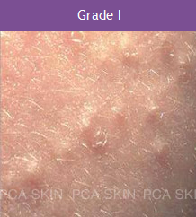 Acne - Grade 1