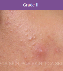 Acne - Grade 2
