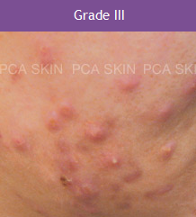 Acne - Grade 3