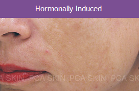 Hormonally Induced
