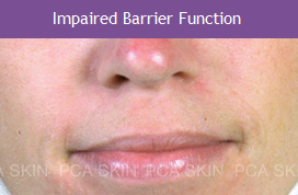 Impaired Barrier Function