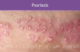 Psoriasis