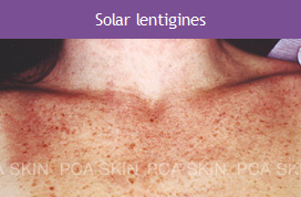 Solar Lentigines