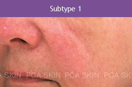 Rosacea - Type 1